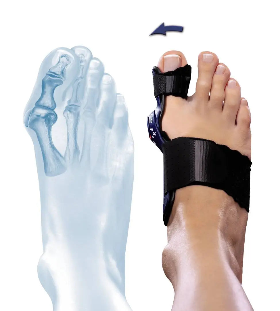 Valguloc II ist eine medizinische Fußorthese zur Unterstützung und Korrektur von Hallux valgus. Sie zeichnet sich durch ihr modernes Design und ihre Funktionalität aus, die eine präzise Anpassung und Druckentlastung bietet.